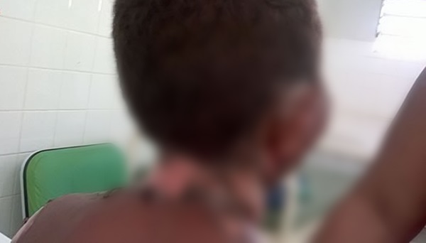 Vitima de agua fervente