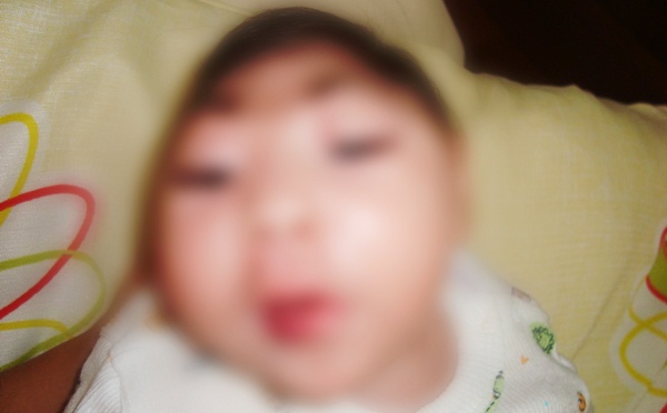 Microcefalia imagem ilustrativa