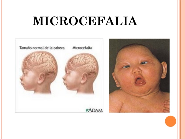 Microcefalia