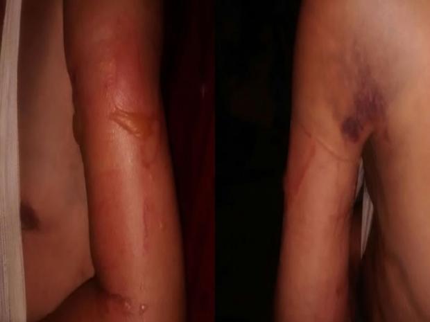 Hamilton de Jesus Santos pode perder o braco