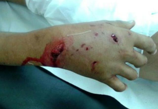 Pedro atacado na bochecha por pit bull